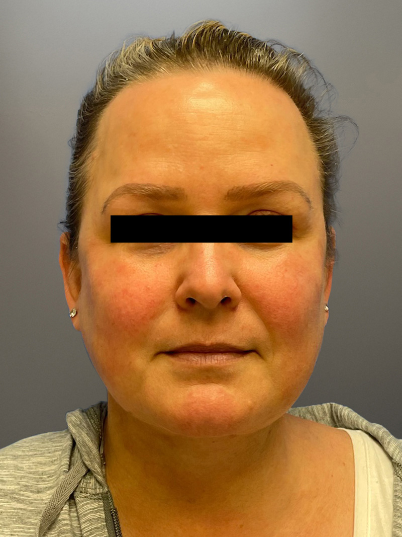 FAT GRAFTING Before & After Gallery - Patient 240927 - Image 2