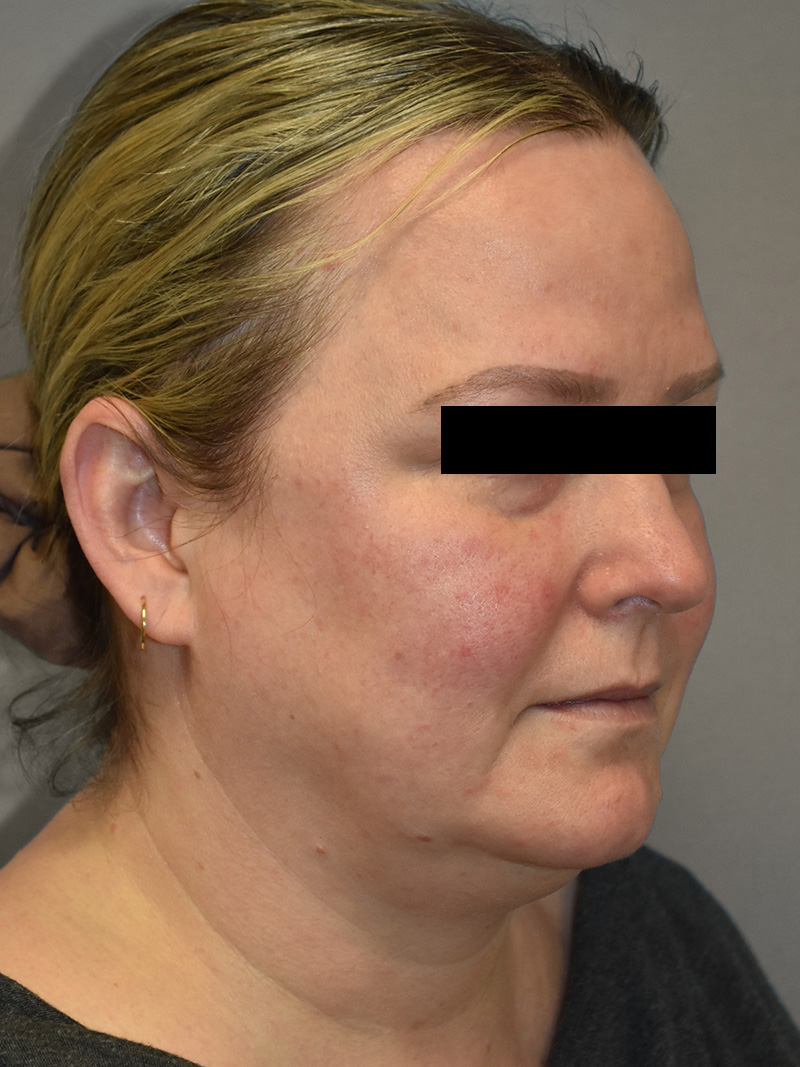 FAT GRAFTING Before & After Gallery - Patient 240927 - Image 5