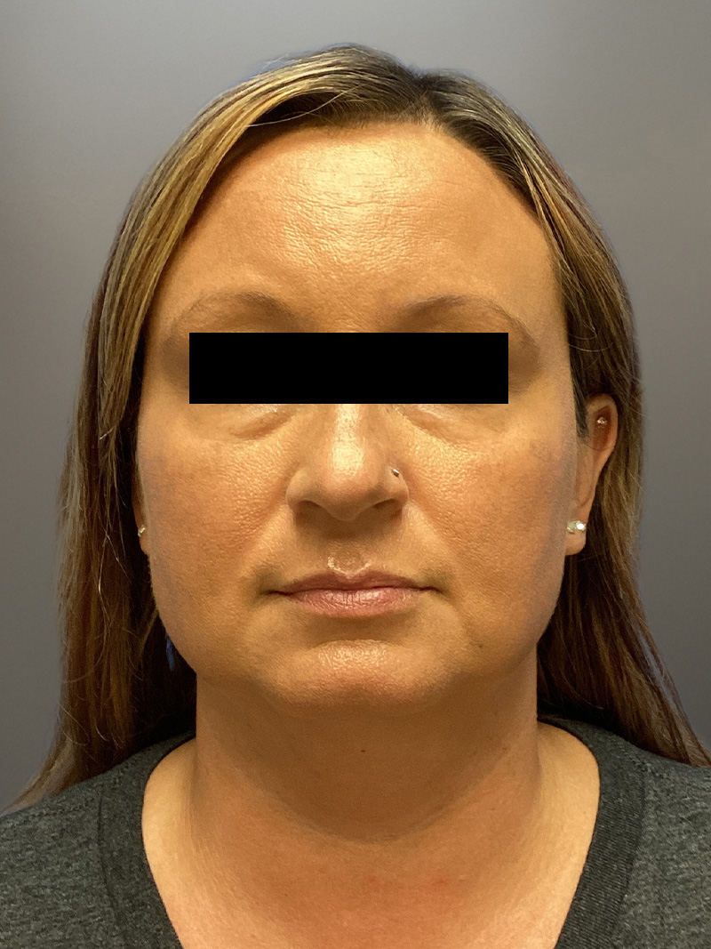 FAT GRAFTING Before & After Gallery - Patient 256676 - Image 1