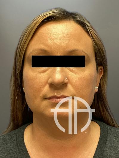 FAT GRAFTING Before & After Gallery - Patient 256676 - Image 1