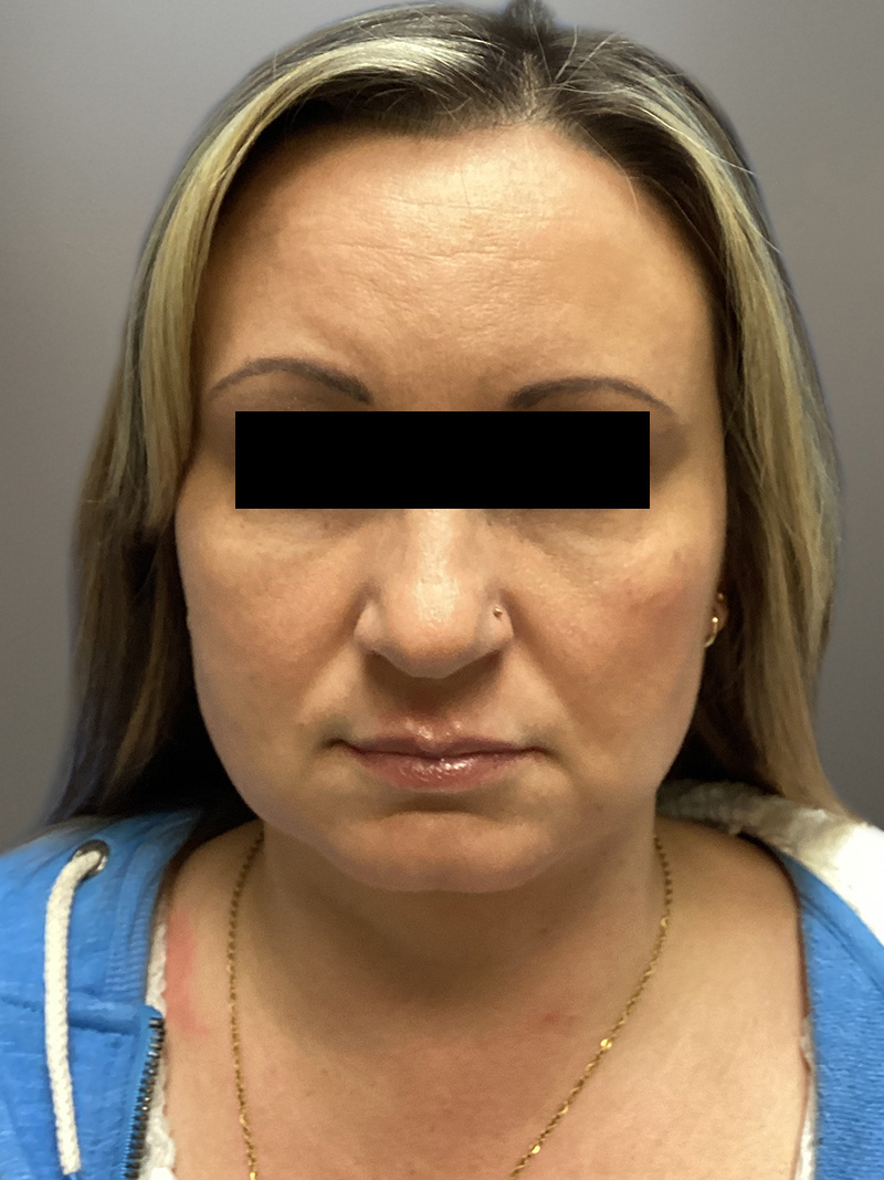 FAT GRAFTING Before & After Gallery - Patient 256676 - Image 2