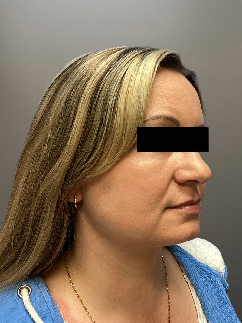 FAT GRAFTING Before & After Gallery - Patient 256676 - Image 4