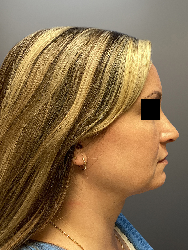 FAT GRAFTING Before & After Gallery - Patient 256676 - Image 6