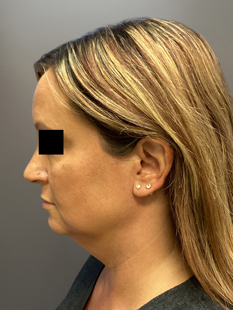 FAT GRAFTING Before & After Gallery - Patient 256676 - Image 7