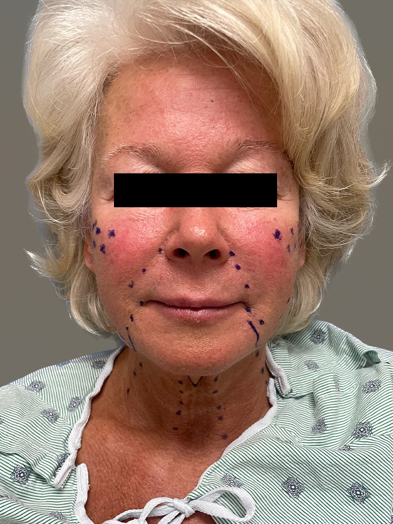 FAT GRAFTING Before & After Gallery - Patient 265704 - Image 1