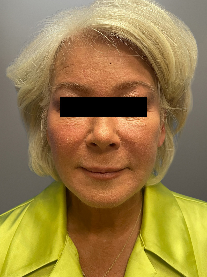 FAT GRAFTING Before & After Gallery - Patient 265704 - Image 2