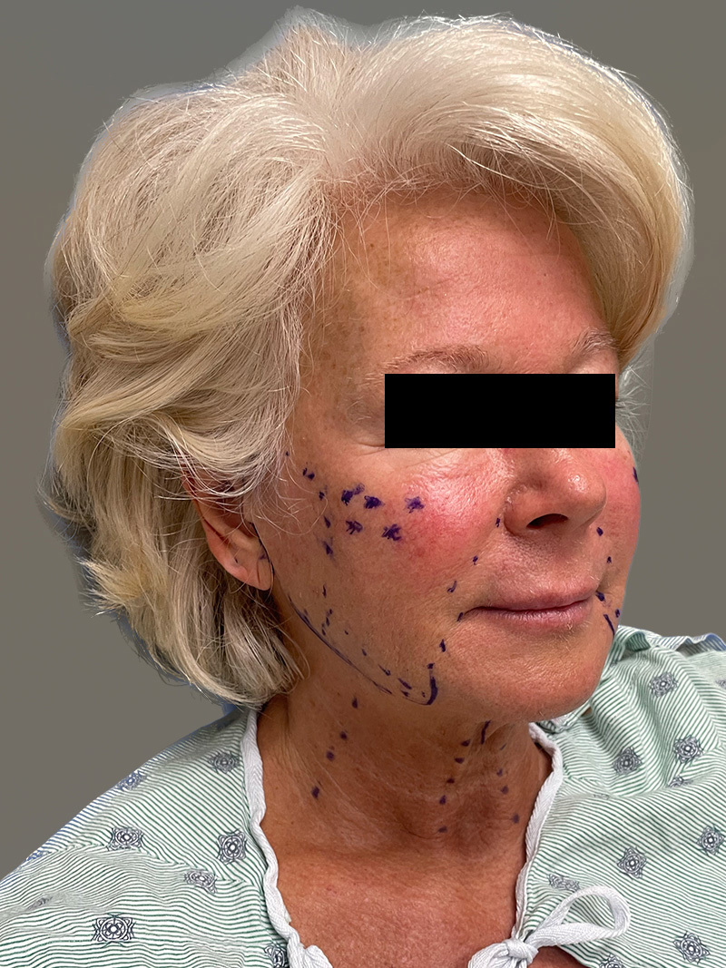 FAT GRAFTING Before & After Gallery - Patient 265704 - Image 3