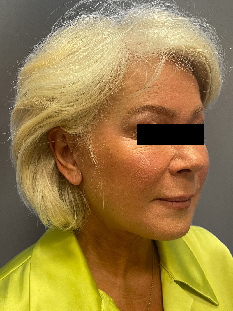 FAT GRAFTING Before & After Gallery - Patient 265704 - Image 4