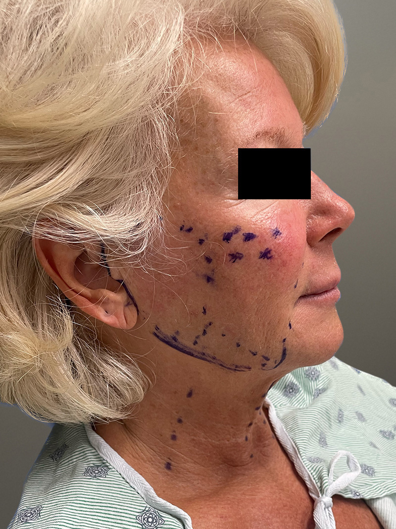 FAT GRAFTING Before & After Gallery - Patient 265704 - Image 5