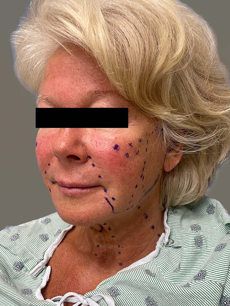 FAT GRAFTING Before & After Gallery - Patient 265704 - Image 7