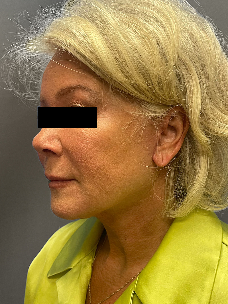 FAT GRAFTING Before & After Gallery - Patient 265704 - Image 8