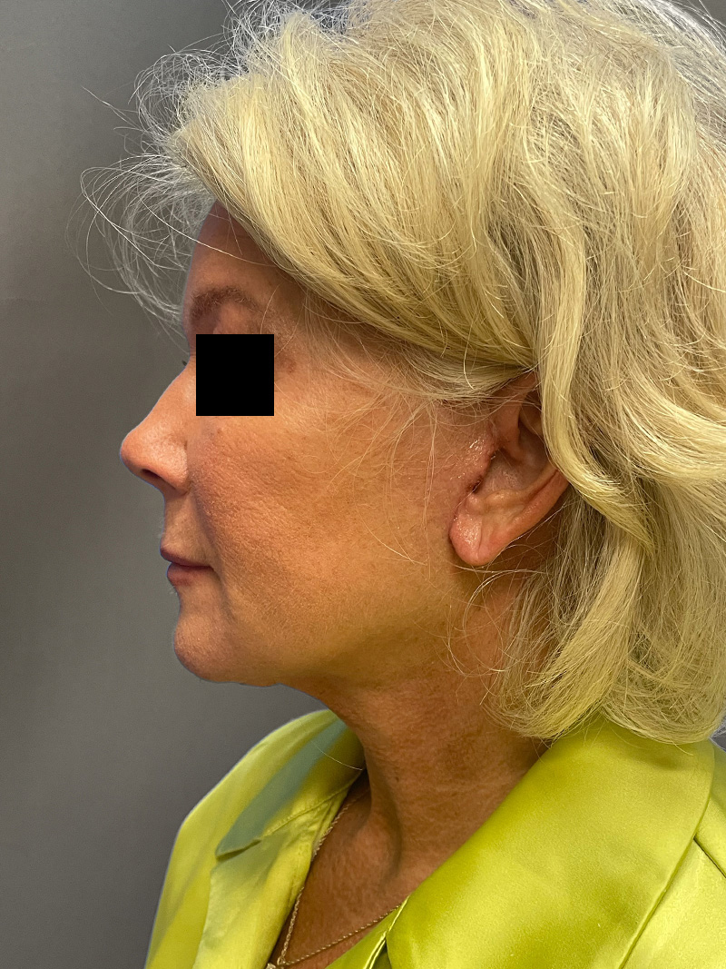 FAT GRAFTING Before & After Gallery - Patient 265704 - Image 10