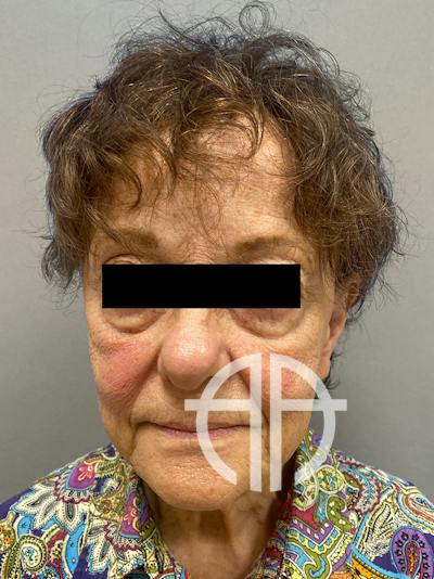 FAT GRAFTING Before & After Gallery - Patient 294356 - Image 1