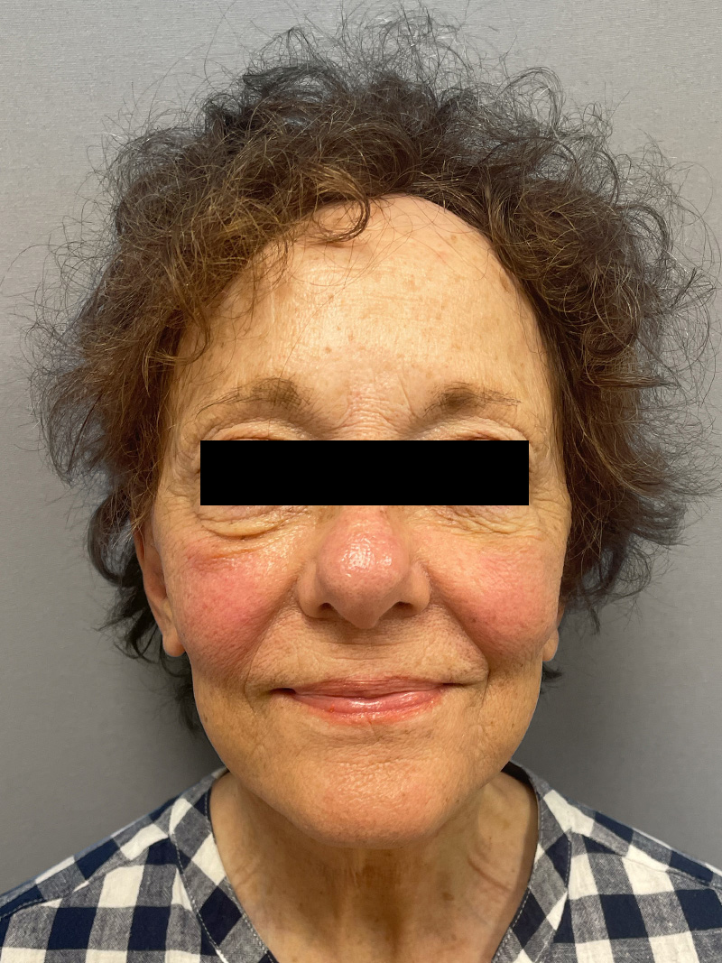 FAT GRAFTING Before & After Gallery - Patient 294356 - Image 2