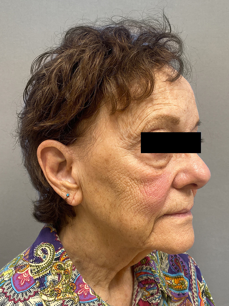 FAT GRAFTING Before & After Gallery - Patient 294356 - Image 3