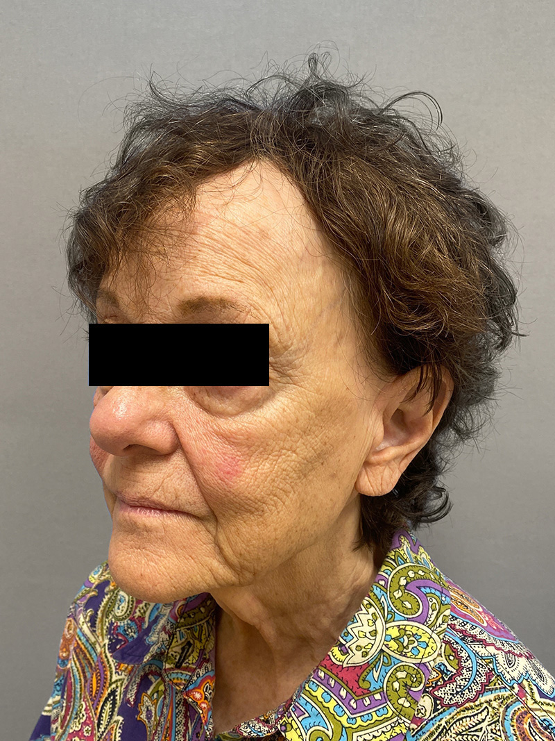 FAT GRAFTING Before & After Gallery - Patient 294356 - Image 7