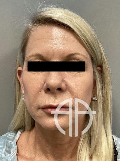 FAT GRAFTING Before & After Gallery - Patient 308684 - Image 1
