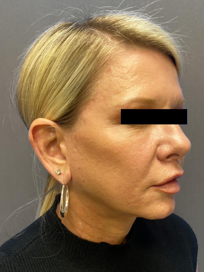 FAT GRAFTING Before & After Gallery - Patient 308684 - Image 4