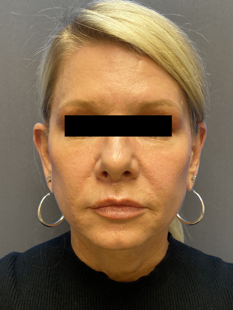 FAT GRAFTING Before & After Gallery - Patient 308684 - Image 2