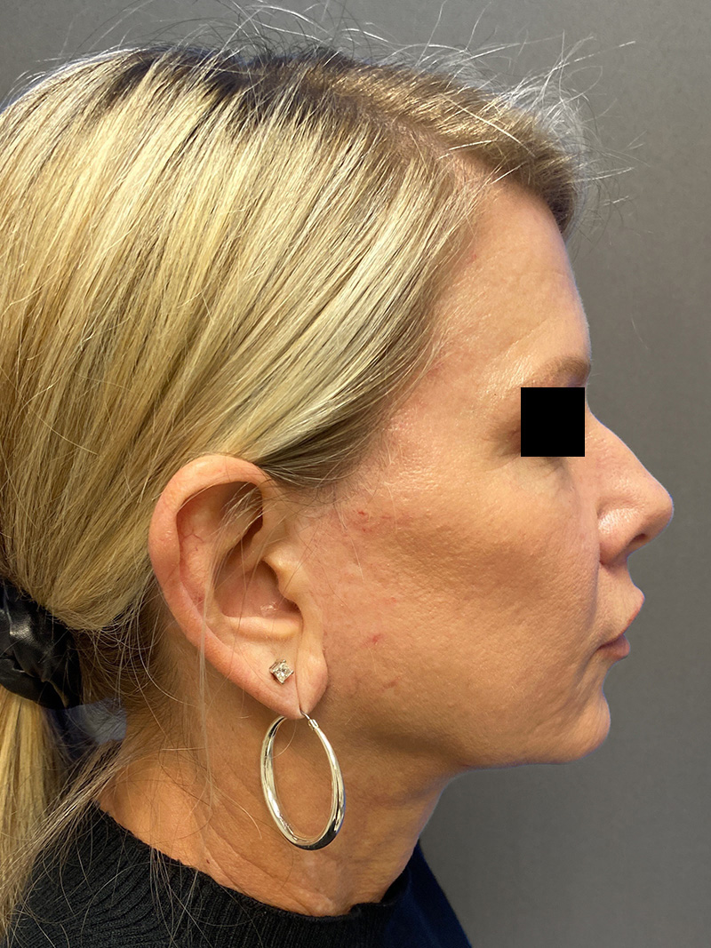 FAT GRAFTING Before & After Gallery - Patient 308684 - Image 6