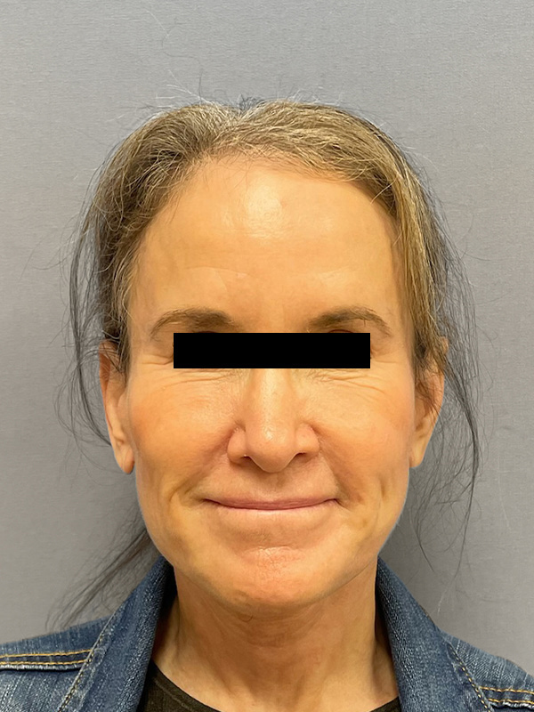 FAT GRAFTING Before & After Gallery - Patient 313116 - Image 2