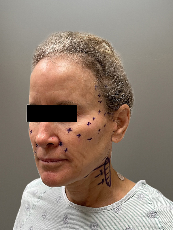 FAT GRAFTING Before & After Gallery - Patient 313116 - Image 7