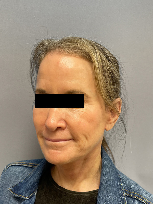 FAT GRAFTING Before & After Gallery - Patient 313116 - Image 8