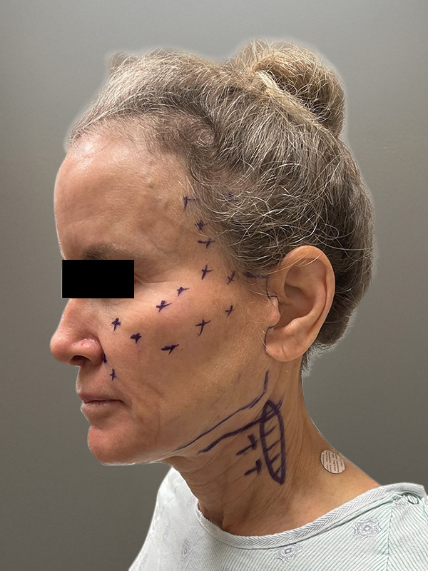 FAT GRAFTING Before & After Gallery - Patient 313116 - Image 9