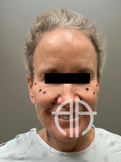 FAT GRAFTING Before & After Gallery - Patient 313116 - Image 1
