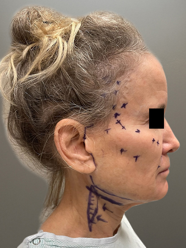 FAT GRAFTING Before & After Gallery - Patient 313116 - Image 5