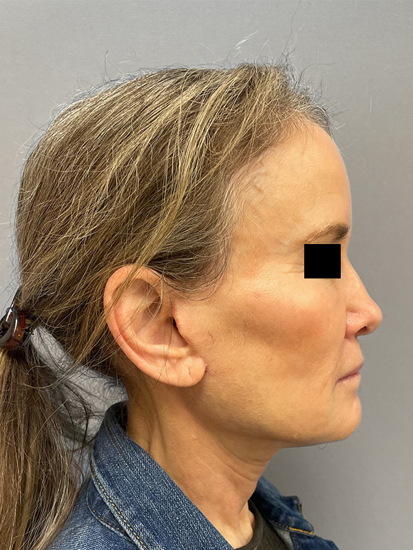 FAT GRAFTING Before & After Gallery - Patient 313116 - Image 6