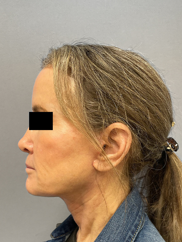 FAT GRAFTING Before & After Gallery - Patient 313116 - Image 10