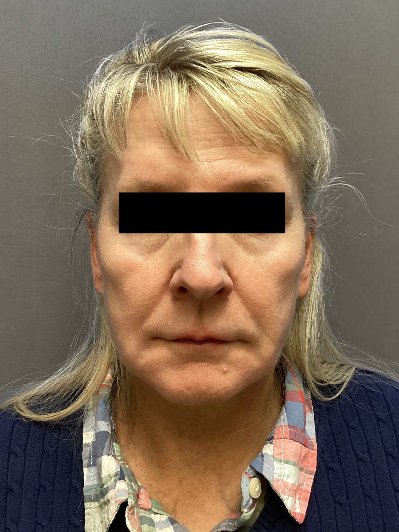 FAT GRAFTING Before & After Gallery - Patient 327226 - Image 1