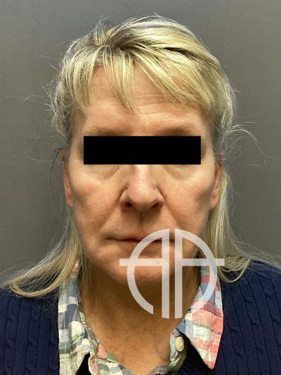 FAT GRAFTING Before & After Gallery - Patient 327226 - Image 1