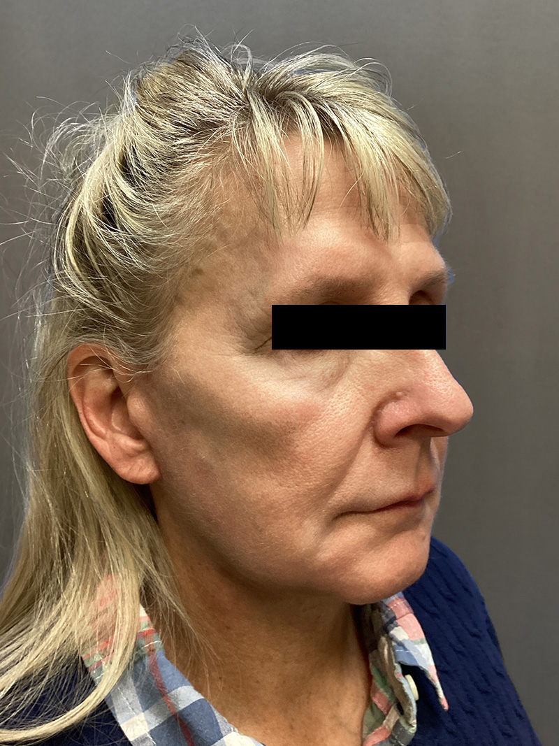 FAT GRAFTING Before & After Gallery - Patient 327226 - Image 3