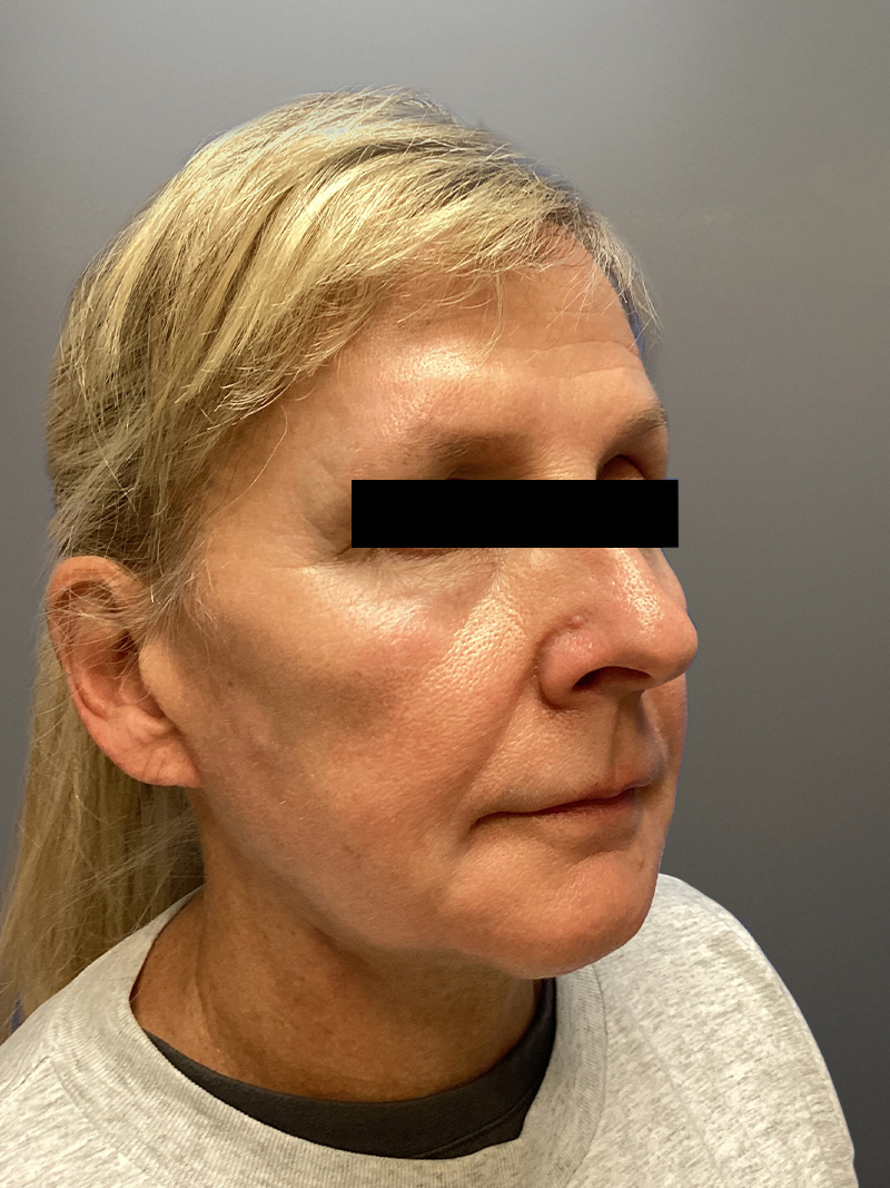 FAT GRAFTING Before & After Gallery - Patient 327226 - Image 4