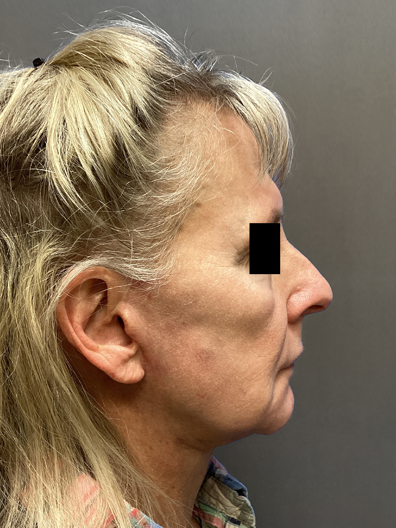 FAT GRAFTING Before & After Gallery - Patient 327226 - Image 5