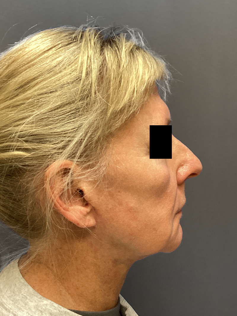 FAT GRAFTING Before & After Gallery - Patient 327226 - Image 6