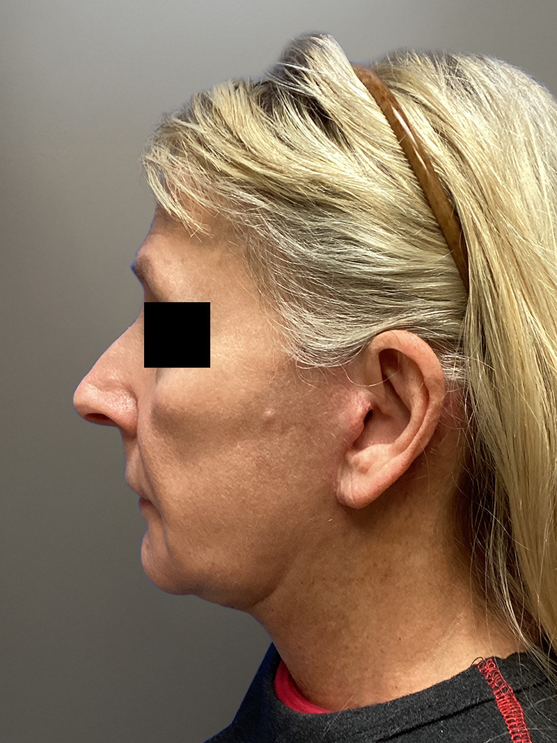 FAT GRAFTING Before & After Gallery - Patient 327226 - Image 7