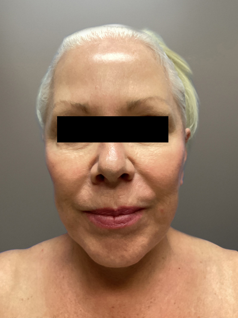 FAT GRAFTING Before & After Gallery - Patient 363118 - Image 2