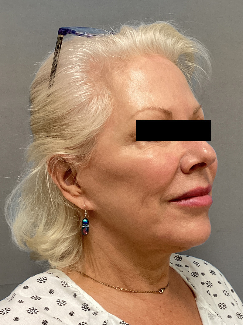 FAT GRAFTING Before & After Gallery - Patient 363118 - Image 3