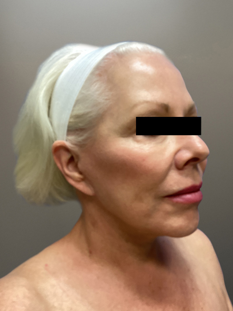 FAT GRAFTING Before & After Gallery - Patient 363118 - Image 4