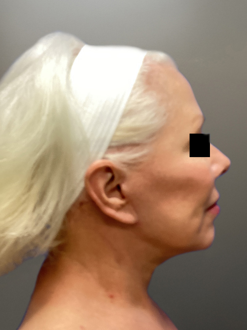 FAT GRAFTING Before & After Gallery - Patient 363118 - Image 6