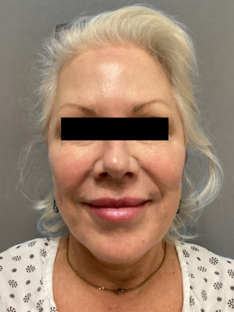 FAT GRAFTING Before & After Gallery - Patient 363118 - Image 1