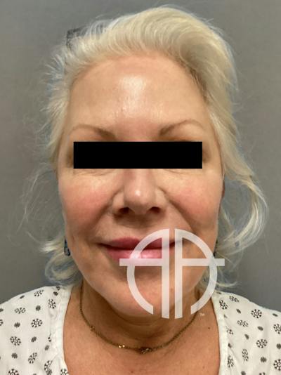 FAT GRAFTING Before & After Gallery - Patient 363118 - Image 1