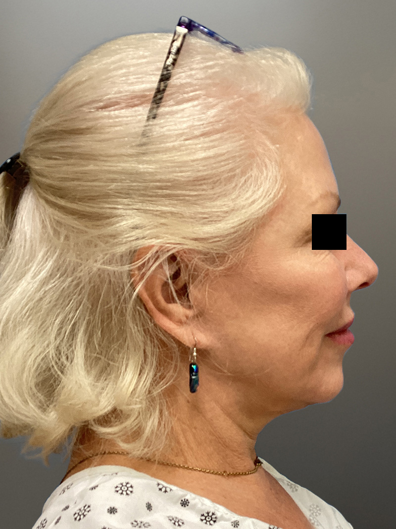 FAT GRAFTING Before & After Gallery - Patient 363118 - Image 5