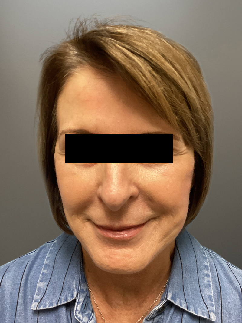 FAT GRAFTING Before & After Gallery - Patient 368601 - Image 1