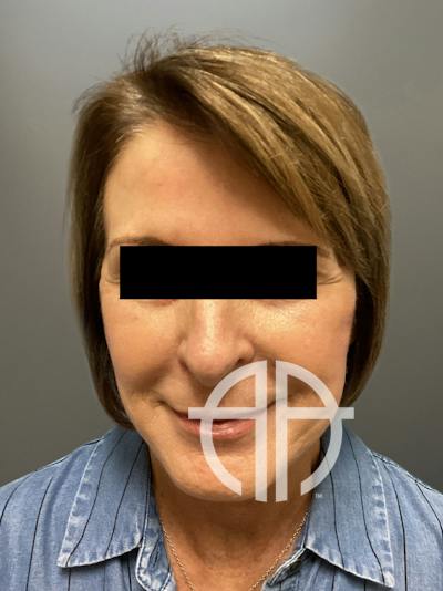 FAT GRAFTING Before & After Gallery - Patient 368601 - Image 1