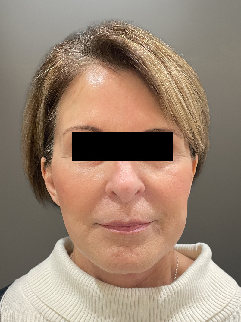 FAT GRAFTING Before & After Gallery - Patient 368601 - Image 2