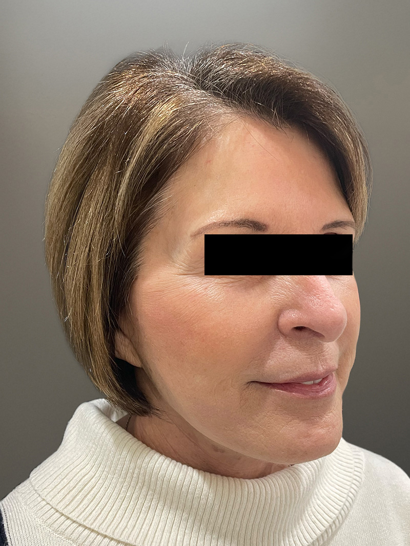 FAT GRAFTING Before & After Gallery - Patient 368601 - Image 4